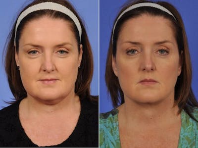 ThermiTight Before & After Gallery - Patient 344272 - Image 1