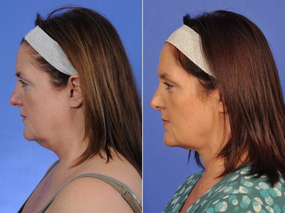 ThermiTight Before & After Gallery - Patient 344272 - Image 4