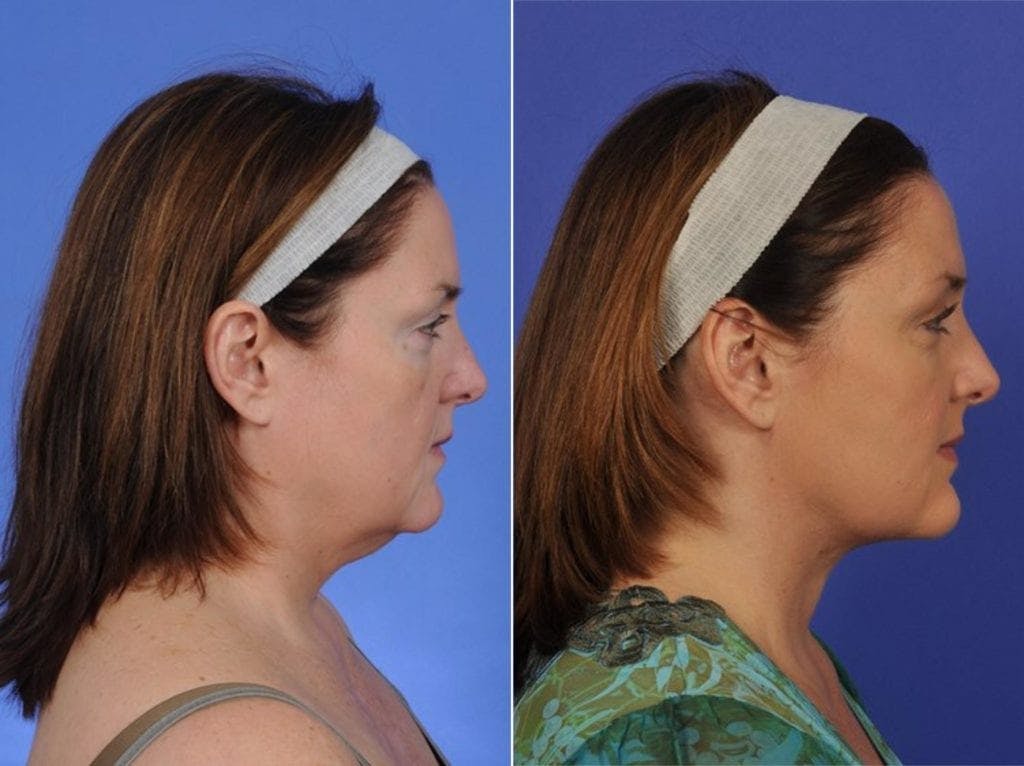 ThermiTight Before & After Gallery - Patient 344272 - Image 5