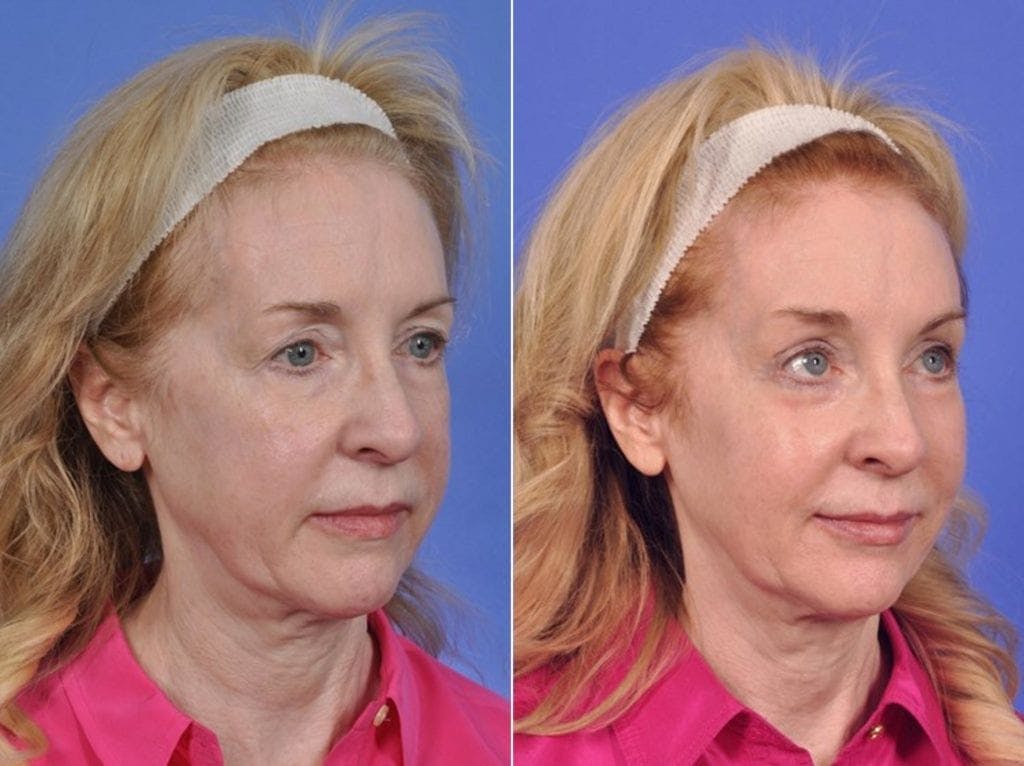 ThermiTight Before & After Gallery - Patient 115798 - Image 2