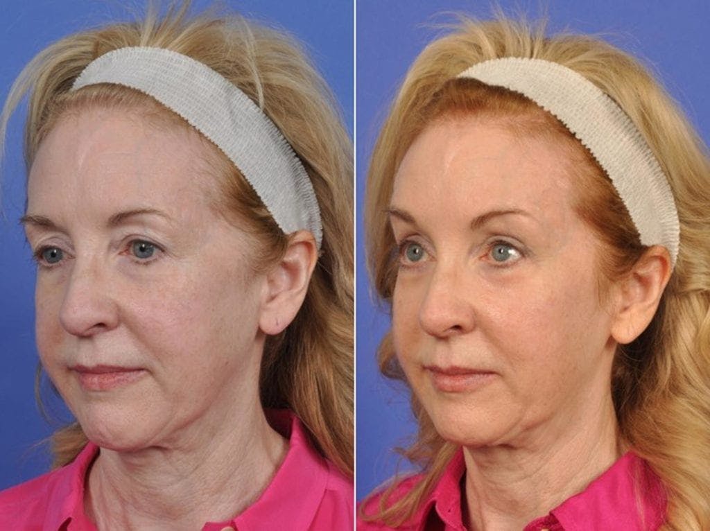 ThermiTight Before & After Gallery - Patient 115798 - Image 3