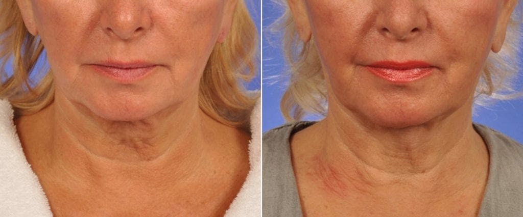 ThermiTight Before & After Gallery - Patient 511594 - Image 1