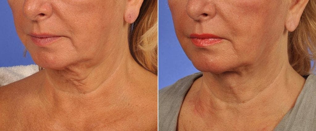 ThermiTight Before & After Gallery - Patient 511594 - Image 2