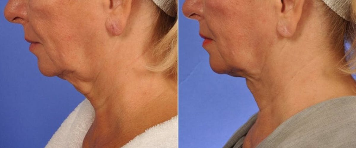 ThermiTight Before & After Gallery - Patient 511594 - Image 3