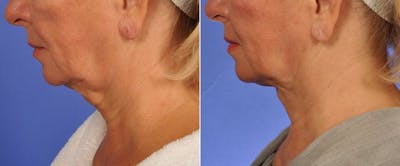 ThermiTight Before & After Gallery - Patient 511594 - Image 3