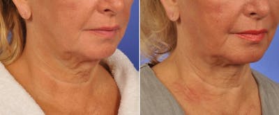 ThermiTight Before & After Gallery - Patient 511594 - Image 4