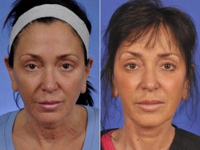 ThermiTight Before & After Gallery - Patient 217598 - Image 1