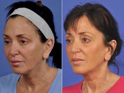 ThermiTight Before & After Gallery - Patient 217598 - Image 2