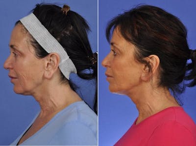ThermiTight Before & After Gallery - Patient 217598 - Image 3