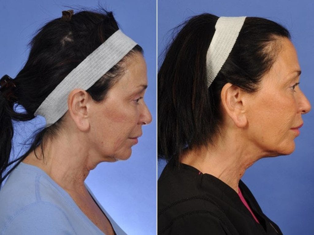 ThermiTight Before & After Gallery - Patient 217598 - Image 4