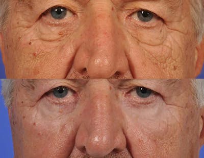 ThermiTight Before & After Gallery - Patient 381620 - Image 1