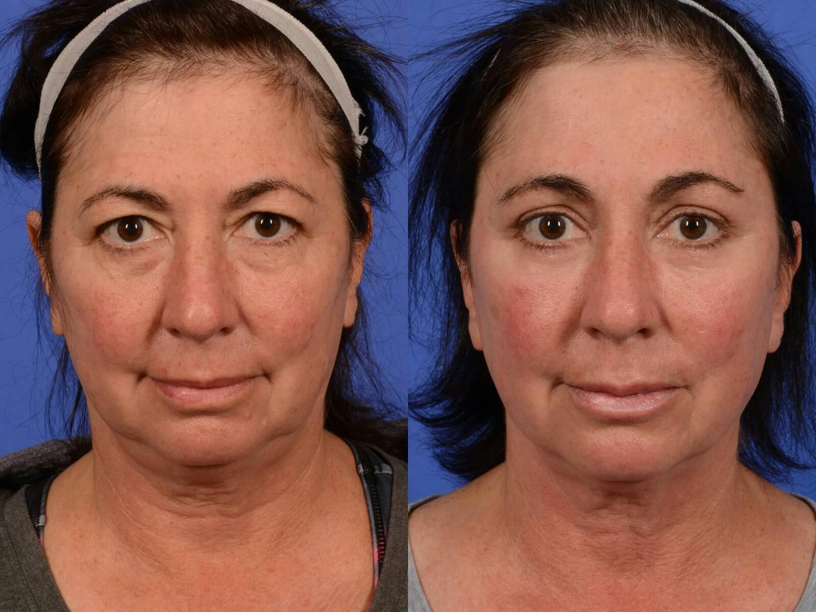 WNatural Micromidfacelift™ Before & After Gallery - Patient 134159 - Image 1