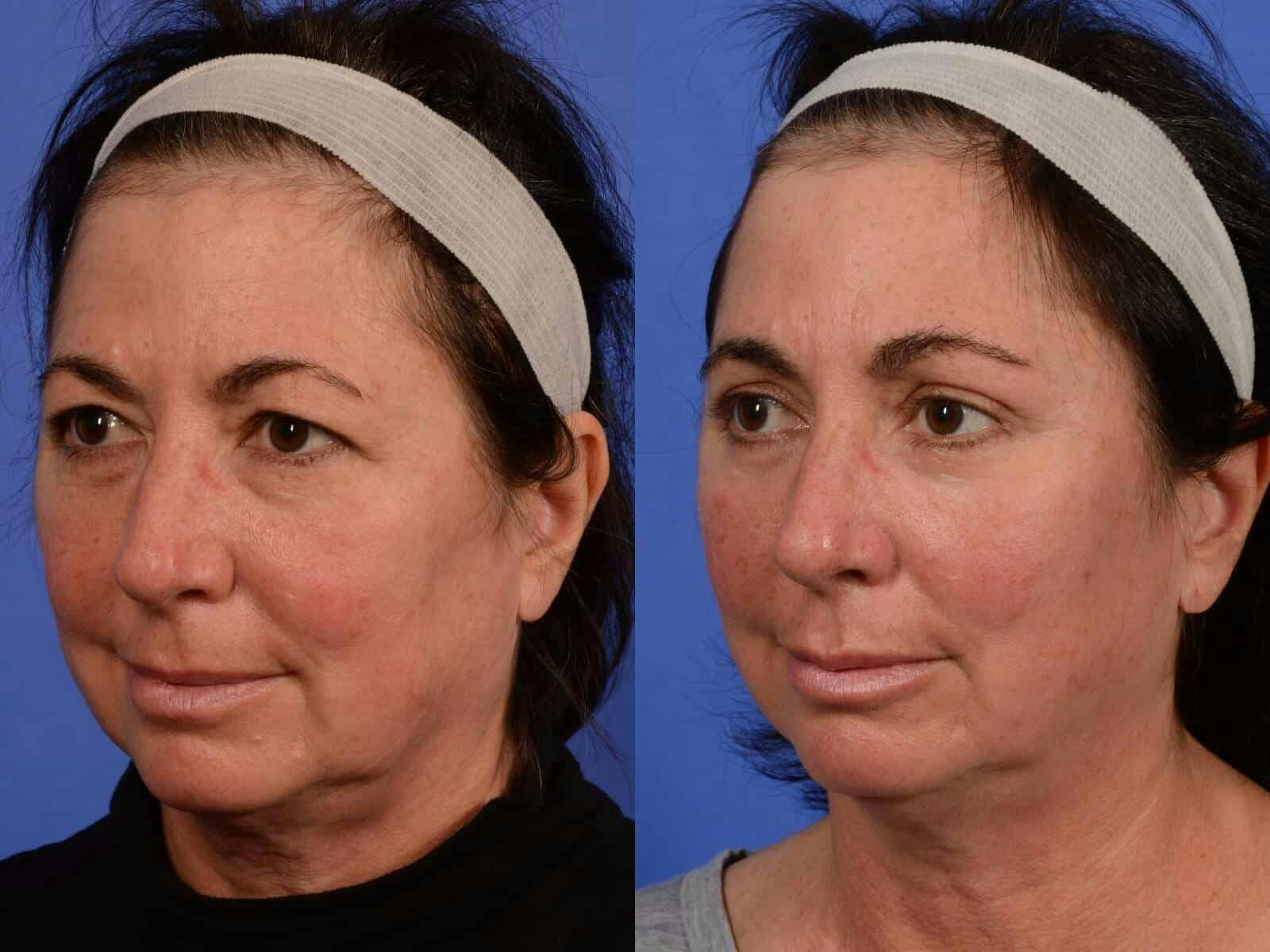 WNatural Micromidfacelift™ Before & After Gallery - Patient 134159 - Image 2