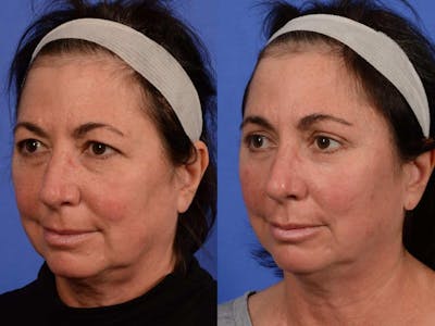 WNatural Micromidfacelift™ Before & After Gallery - Patient 134159 - Image 2