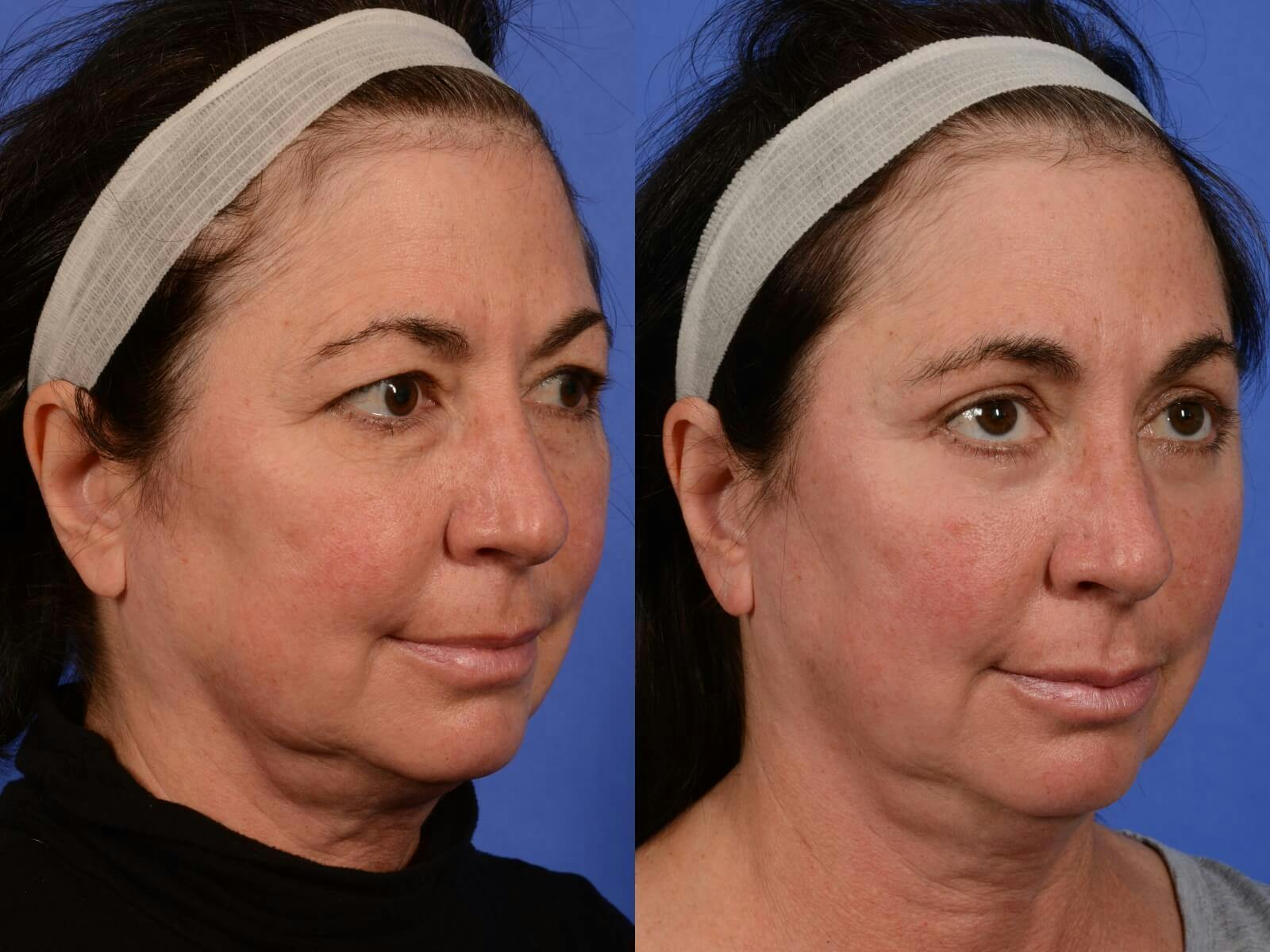 WNatural Micromidfacelift™ Before & After Gallery - Patient 134159 - Image 3