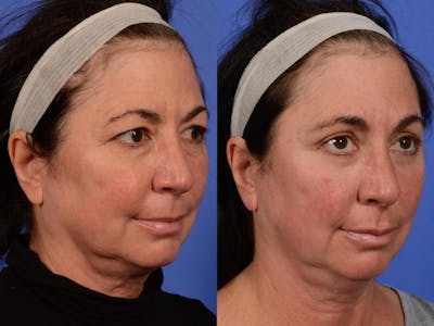WNatural Micromidfacelift™ Before & After Gallery - Patient 134159 - Image 3