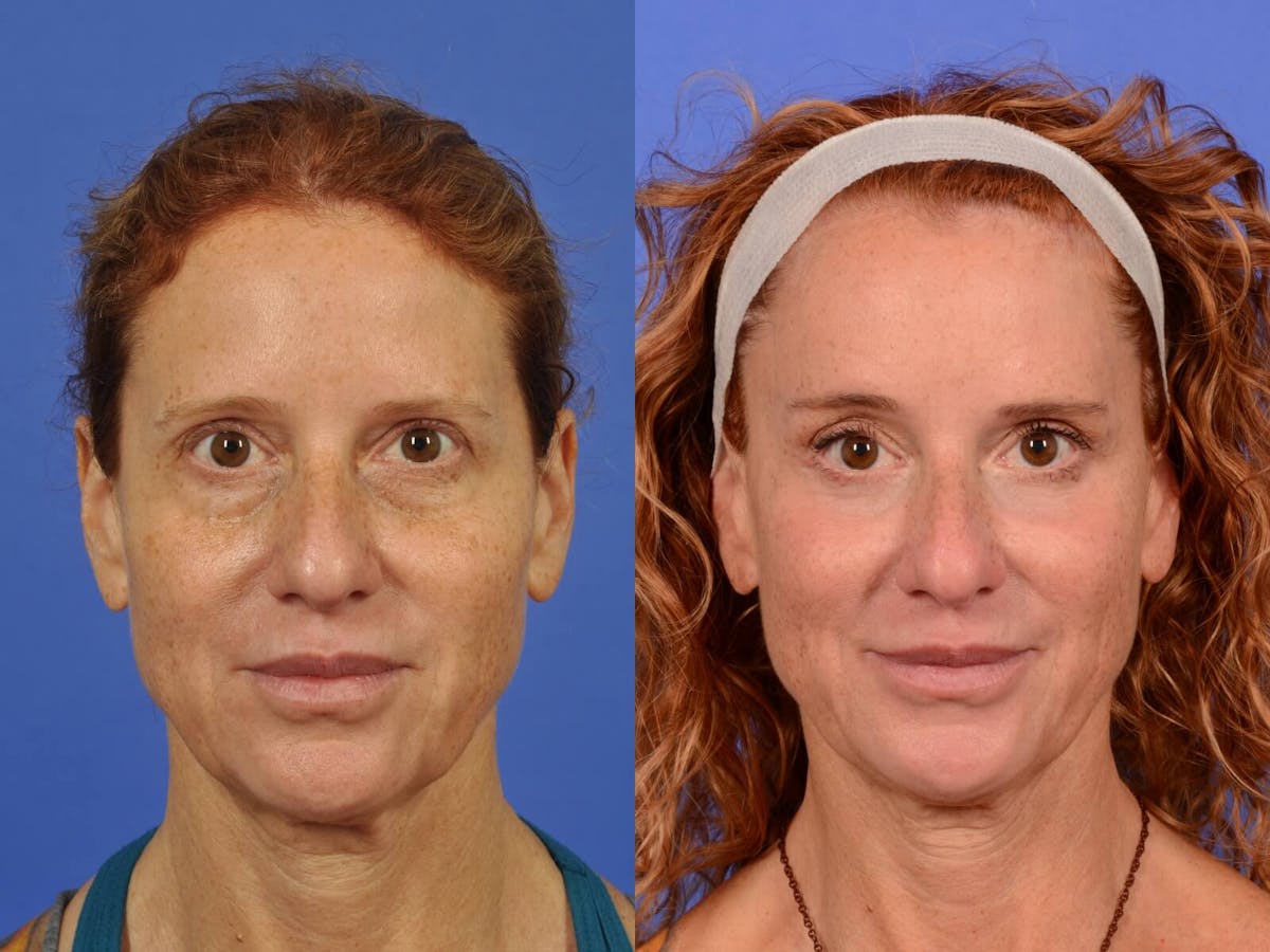 WNatural Micromidfacelift™ Before & After Gallery - Patient 210800 - Image 1