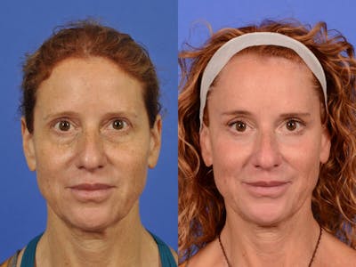 WNatural Micromidfacelift™ Before & After Gallery - Patient 210800 - Image 1