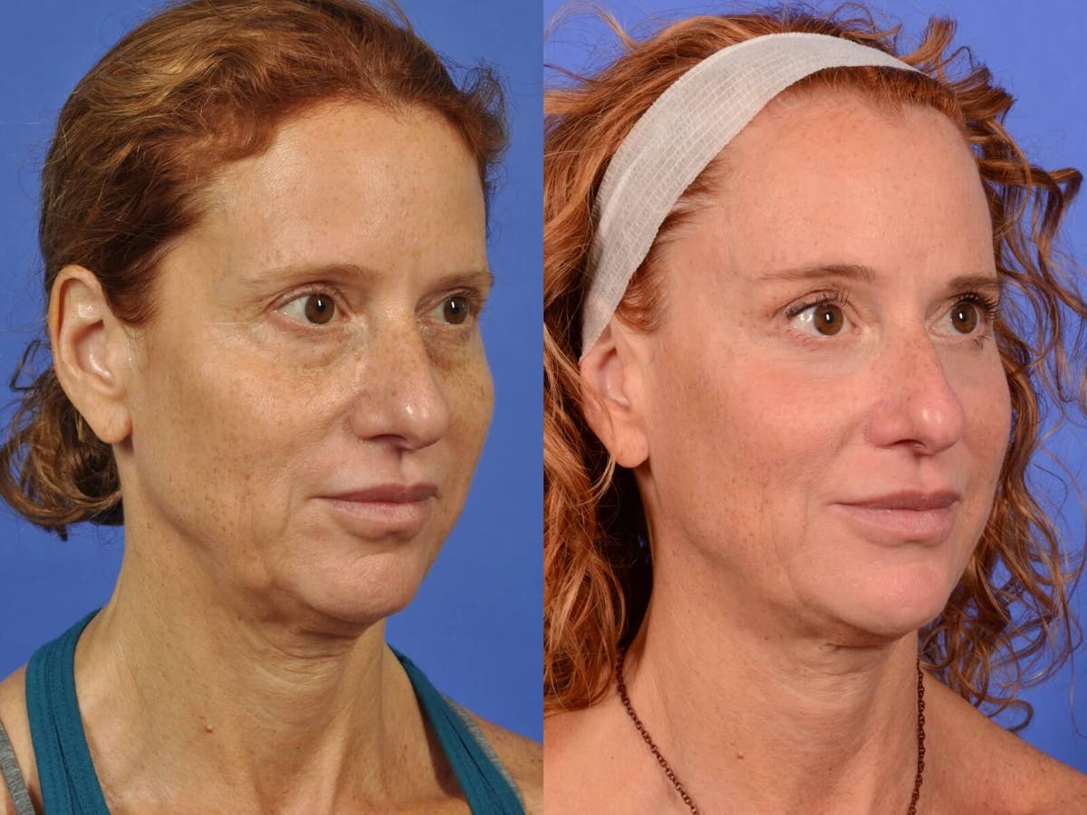 WNatural Micromidfacelift™ Before & After Gallery - Patient 210800 - Image 2