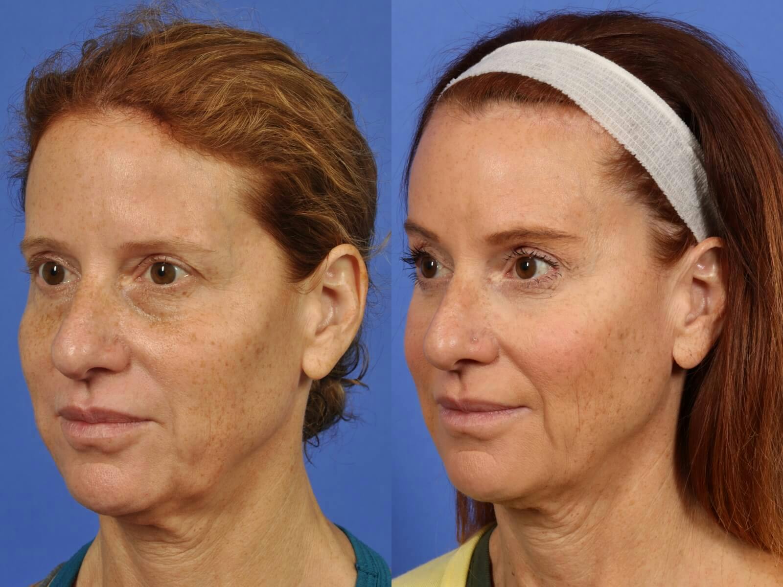 WNatural Micromidfacelift™ Before & After Gallery - Patient 210800 - Image 3