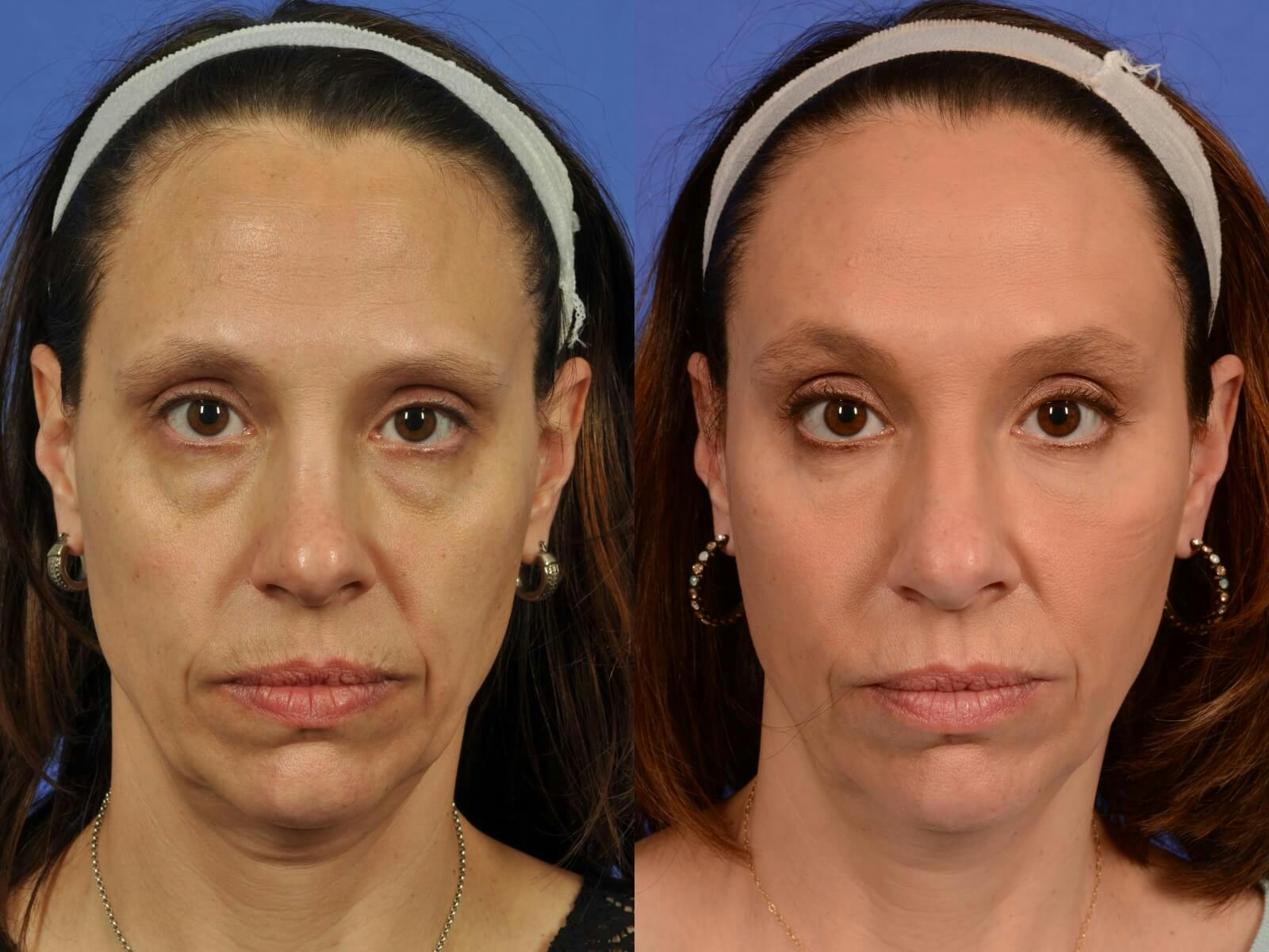 WNatural Micromidfacelift™ Before & After Gallery - Patient 322969 - Image 1