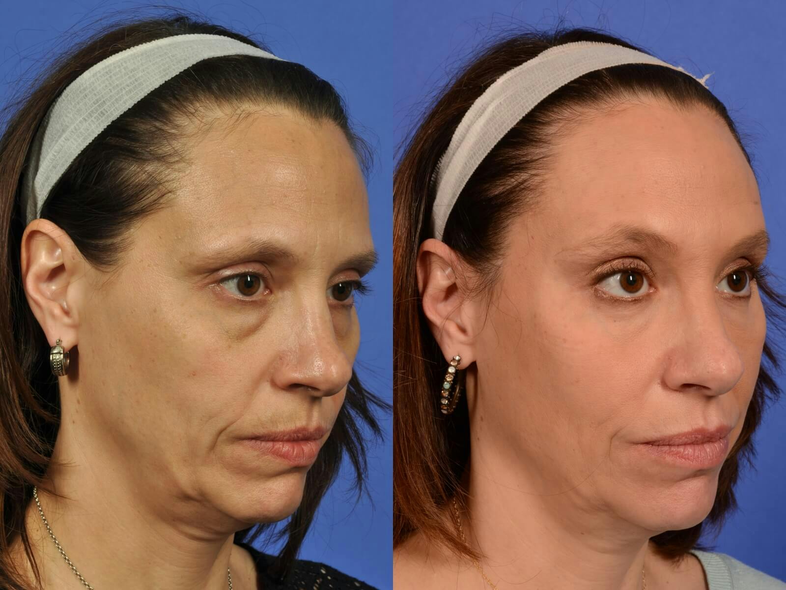 WNatural Micromidfacelift™ Before & After Gallery - Patient 322969 - Image 2