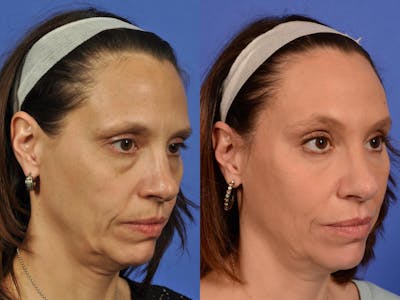 WNatural Micromidfacelift™ Before & After Gallery - Patient 322969 - Image 2