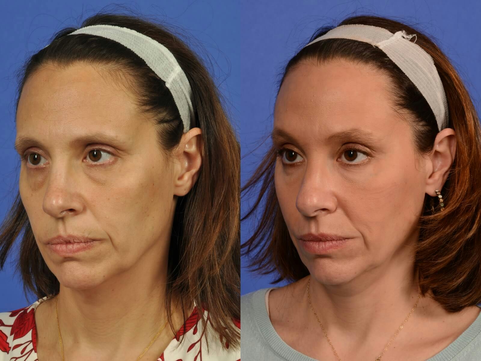 WNatural Micromidfacelift™ Before & After Gallery - Patient 322969 - Image 3
