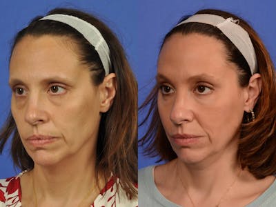 WNatural Micromidfacelift™ Before & After Gallery - Patient 322969 - Image 3