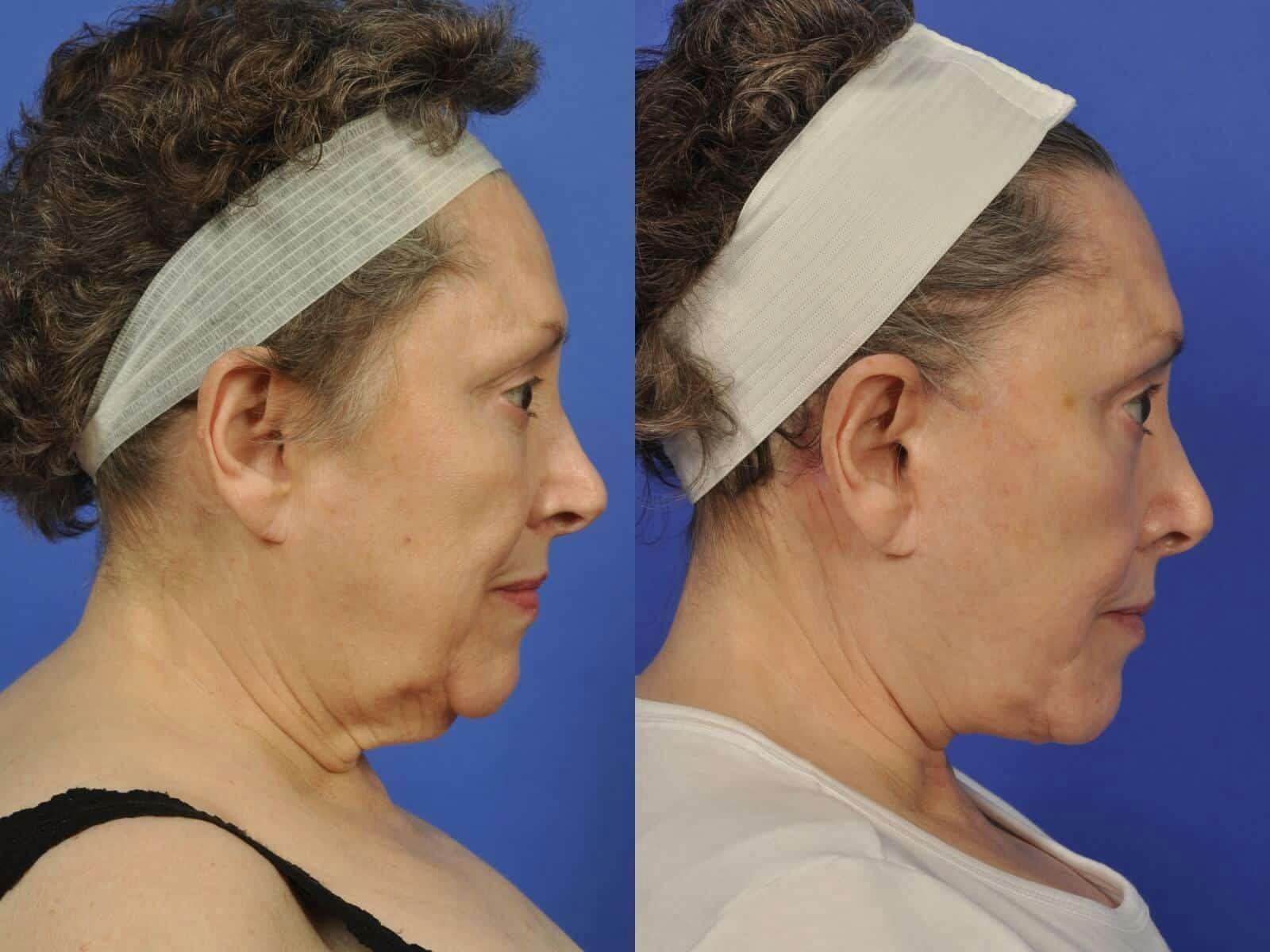 WNatural Micromidfacelift™ Before & After Gallery - Patient 169818 - Image 5