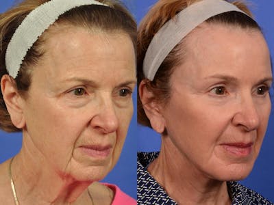 WNatural Micromidfacelift™ Before & After Gallery - Patient 318694 - Image 3