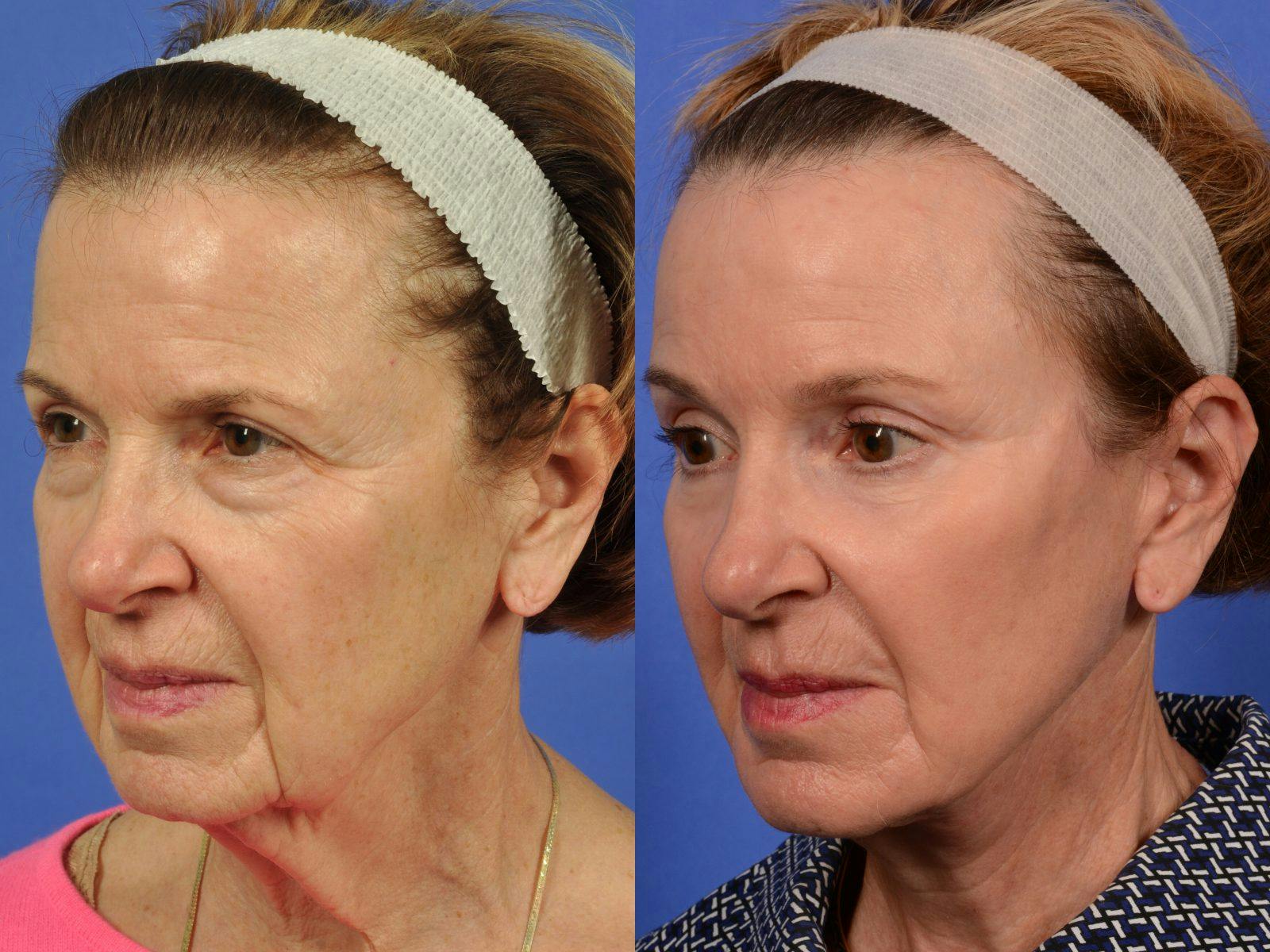 WNatural Micromidfacelift™ Before & After Gallery - Patient 318694 - Image 4