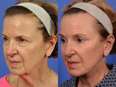 WNatural Micromidfacelift™ Before & After Gallery - Patient 318694 - Image 4