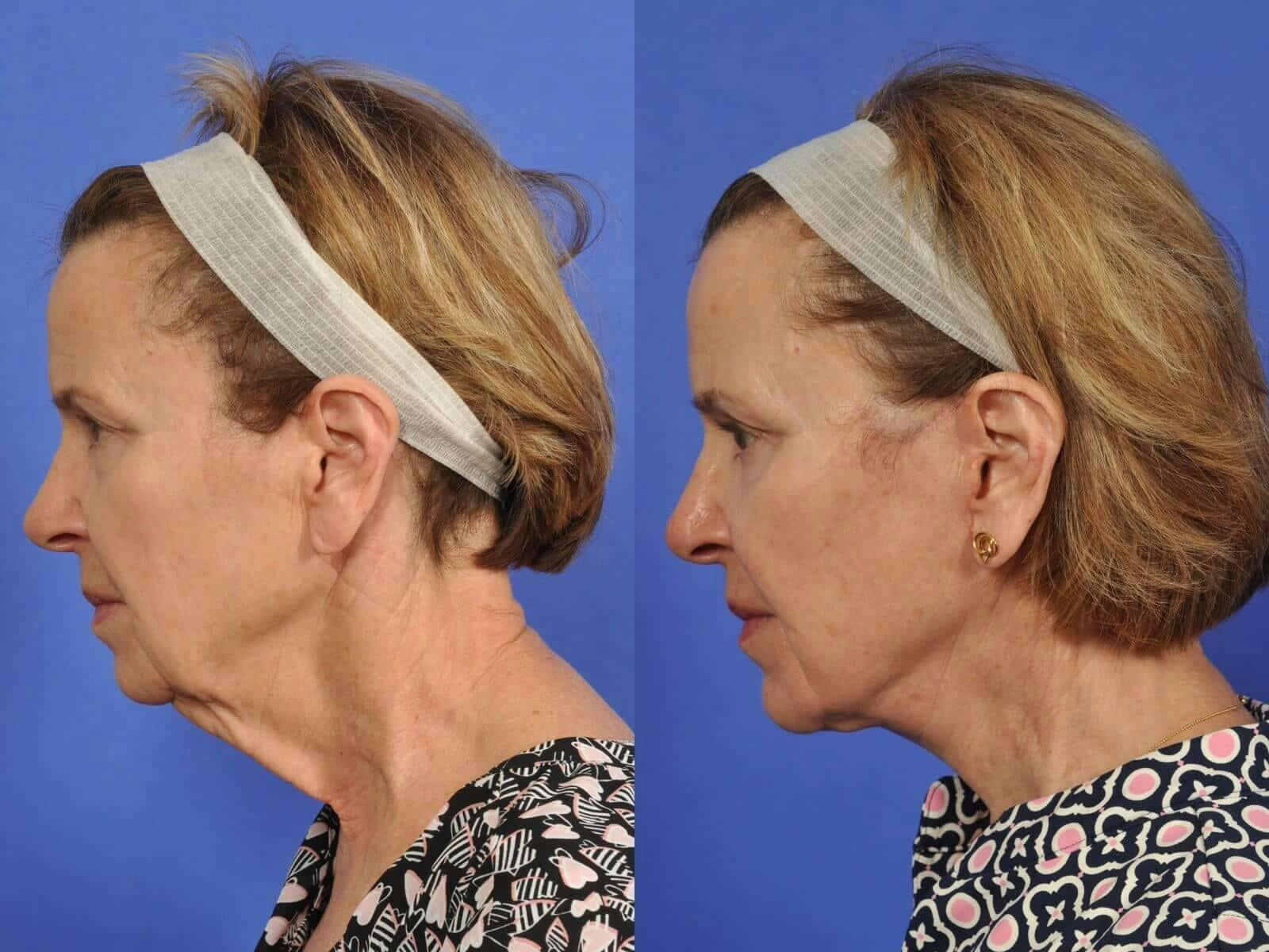 WNatural Micromidfacelift™ Before & After Gallery - Patient 318694 - Image 6