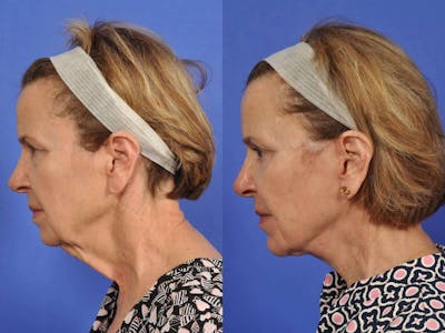 WNatural Micromidfacelift™ Before & After Gallery - Patient 318694 - Image 6