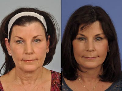 WNatural Micromidfacelift™ Before & After Gallery - Patient 228790 - Image 1