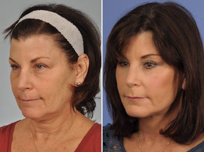 WNatural Micromidfacelift™ Before & After Gallery - Patient 228790 - Image 2