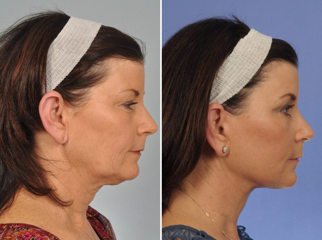 WNatural Micromidfacelift™ Before & After Gallery - Patient 228790 - Image 5