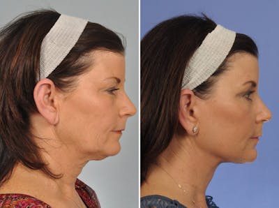 WNatural Micromidfacelift™ Before & After Gallery - Patient 228790 - Image 5