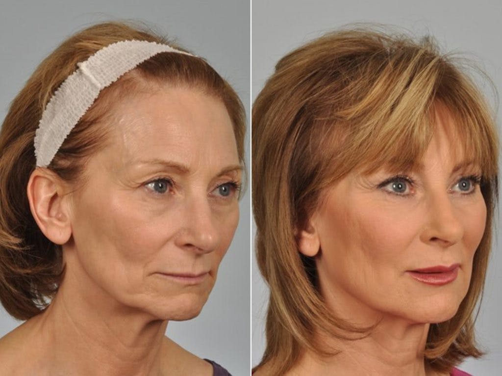 WNatural Micromidfacelift™ Before & After Gallery - Patient 352852 - Image 2