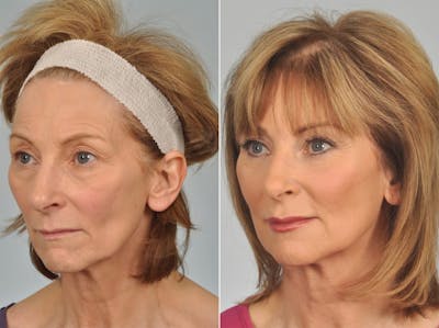 WNatural Micromidfacelift™ Before & After Gallery - Patient 352852 - Image 3