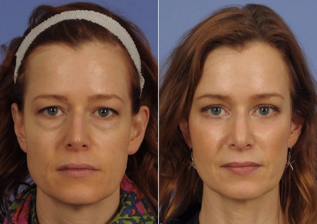 WNatural Micromidfacelift™ Before & After Gallery - Patient 112110 - Image 1