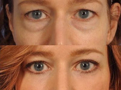 WNatural Micromidfacelift™ Before & After Gallery - Patient 112110 - Image 2