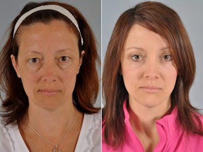 WNatural Micromidfacelift™ Before & After Gallery - Patient 228107 - Image 1