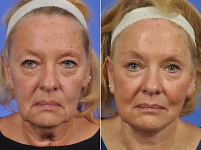 WNatural Micromidfacelift™ Before & After Gallery - Patient 658193 - Image 1