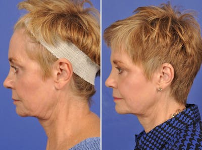 WNatural Micromidfacelift™ Before & After Gallery - Patient 325146 - Image 5