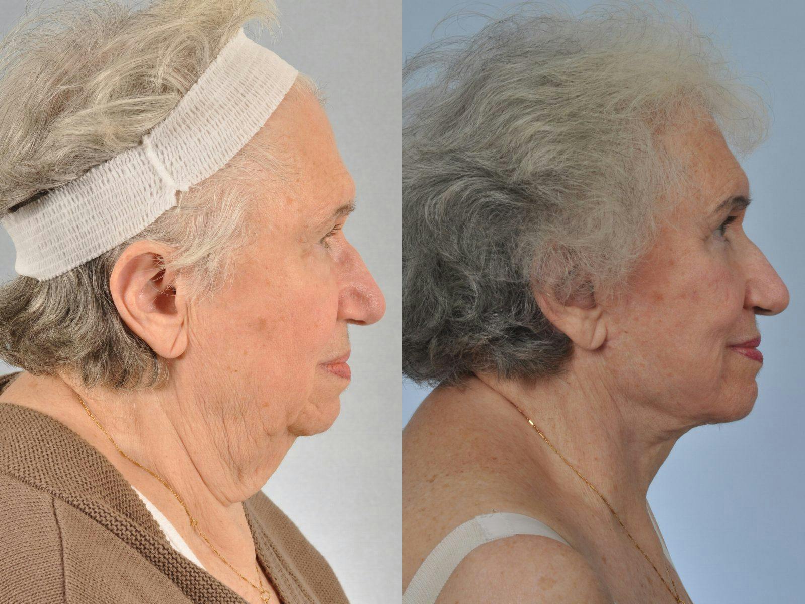 WNatural Micromidfacelift™ Before & After Gallery - Patient 186245 - Image 5