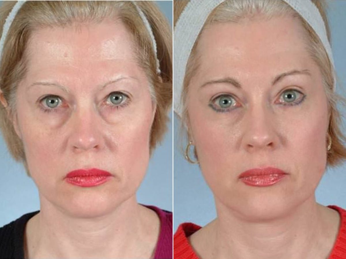 WNatural Micromidfacelift™ Before & After Gallery - Patient 370703 - Image 1
