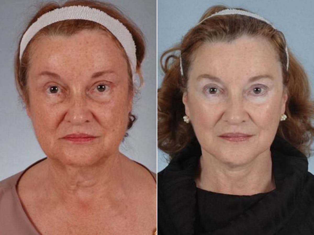 WNatural Micromidfacelift™ Before & After Gallery - Patient 234417 - Image 1