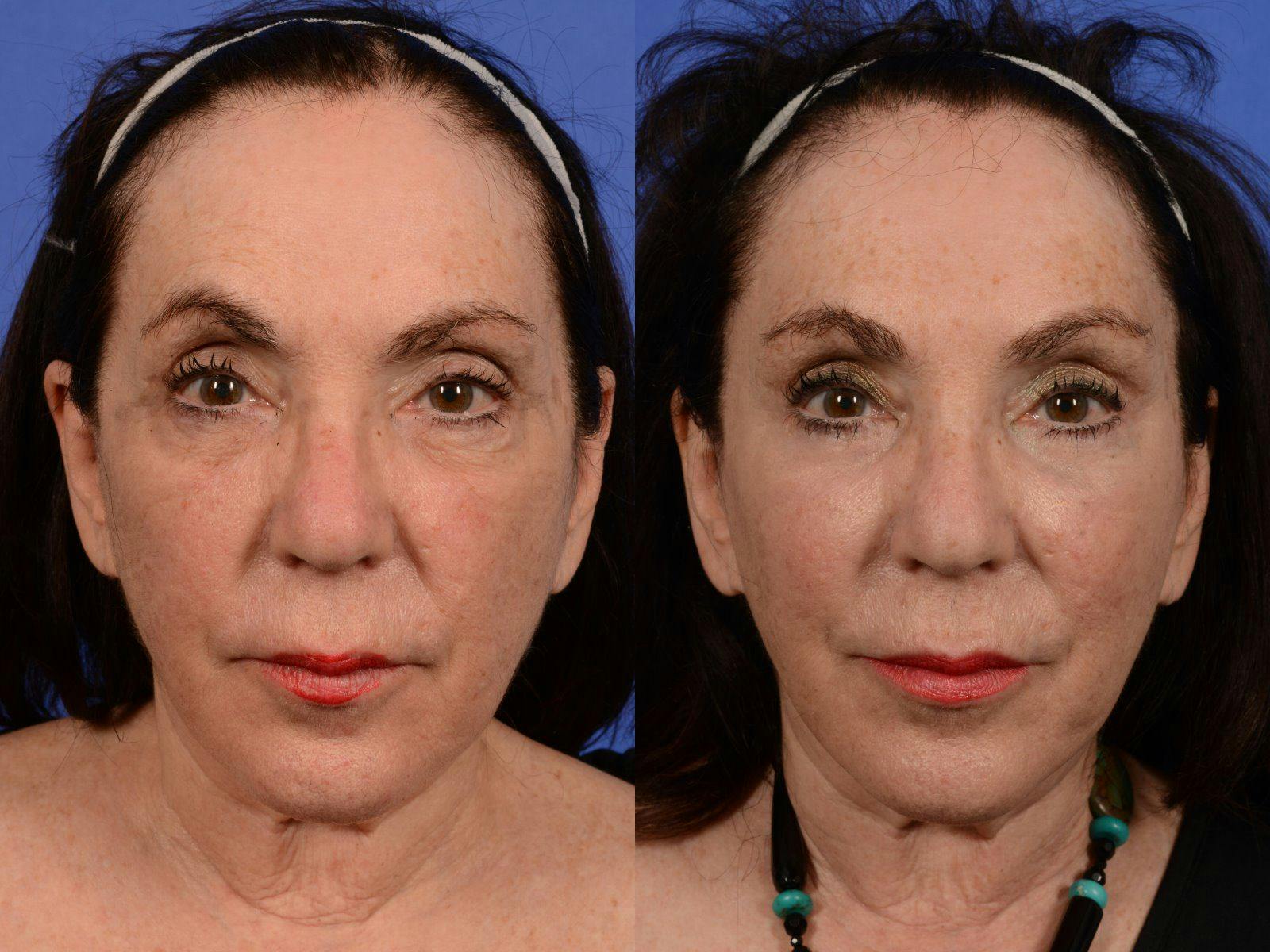 Mid Facelift Before & After Gallery - Patient 375862 - Image 1